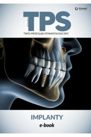 eBook Implanty pdf