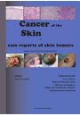 eBook Cancer of the Skin - case reports of skin tumors pdf epub